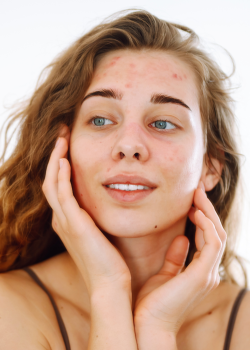 soin visage impuretés