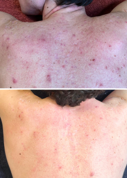 peeling dos soin anti imperfections dos homme